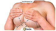 Aptos threading breasts | Breast lift with thread - ir Persiatour