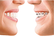 Best Dental Braces Orthodontic Treatment Services in Delhi, South Delhi, Greater Kailash