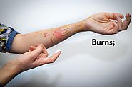 How to Treat Burns Naturally? Remedies You Should Try | How to Cure