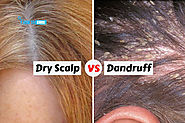 Dandruff vs Dry Scalp - The Difference and Treatment | How to Cure