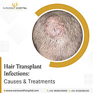 What are the Chances of Hair Transplant Infections & How to Treat Them?