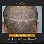 Can Hair Transplants Lead to Scars & How to Remove Them?