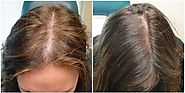 أسرع 5 وصفات لعلاج ومنع تساقط الشعر من الجذور
