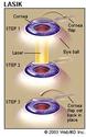 LASIK Laser Eye Surgery: Procedure, Recovery, and Side Effects
