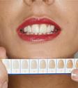 Teeth Whitening - Bleaching Risks, Rewards, & Costs