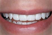 Teeth Whitening | American Academy of Cosmetic Dentistry