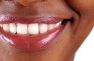 Teens and teeth whitening - Delta Dental