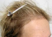 Stem cells used for hair loss treatment in Sarasota