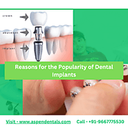 Reasons for the Popularity of Dental Implants