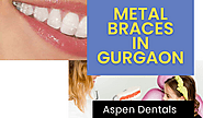 FAQs About Ceramic Braces for Kids