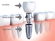 Dental Implants for Old Age People