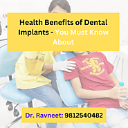 Health Benefits of Dental Implants - You Must Know About