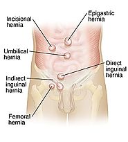 Hernia Treatment in Ayurveda