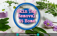 Skin Tag Removal At Home