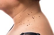 Guam Dermatologist – Skin tags removal treatment