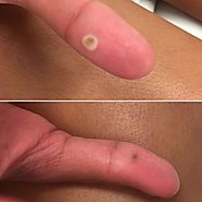 Best Guam Dermal Clinic for Wart removal
