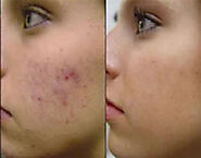 Guam Dermatology - Acne Scar Removal treatment in Guam