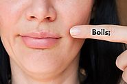 How to Get Rid of Boils Using Natural Remedies| How to Cure