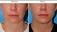 Improve your facial and body features with cosmetic surgery