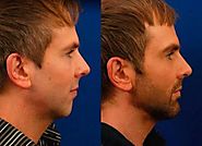 Change the Shape of your Chin with Chin Augmentation