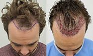 Website at https://www.dynamiclinic.com/hair-transplant/cost-of-hair-transplant/