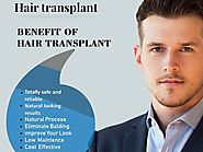 Benefits of hair transplantation
