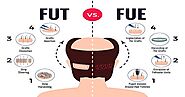 Among FUT and FUE- Which Is the Best Hair Transplant Technique?