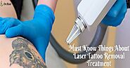 Don’t regret and remove your tattoo with laser tattoo removal treatment