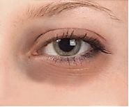 How To Remove Dark Circles Around Eyez - Sensod - Create. Connect. Brand.