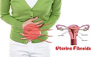 An A to Z guide on uterine fibroids