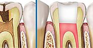 Positive Effects of Referring Root Canal Treatment
