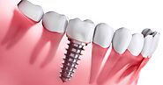 Replenishing Oral Health with Dental Implants