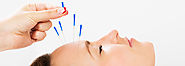 Looking for Cosmetic Acupuncture Treatment in Perth, Australia?? Visit Here