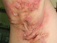 Hidradenitis Suppurativa Carries Heavy Comorbidity Burden