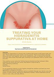 Treating Your Hidradenitis Suppurativa At Home