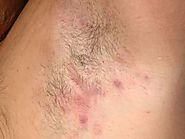 Hidradenitis Suppurativa: Treatment, Symptoms, And Pictures