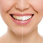 Teeth Whitening Etobicoke – An Important Part Of Your Dental Care