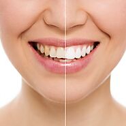 Website at https://www.bloglovin.com/@dentalhealthclinic/dental-implants-choosing-between-titanium