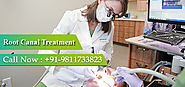 Root Canal Treatment in Delhi, Rohini – Kapil Dental Clinic