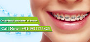 Orthodontic Treatment in Delhi, Rohini- Kapil Dental Clinic