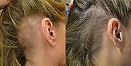 טיפול PRP לנשירת שיער במרפאה הראשית בירושלים  בטכנולוגיה המתקדמת בעולם לעיבוי חיזוק ועידוד צמיחת השיער  