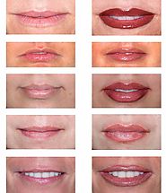 עיבוי שפתיים בבני ברק | עיצוב שפתיים בבני ברק | מילוי שפתיים בבני ברק ע" רופאים מומחים במראה טבעי