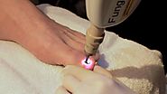 Laser Treatment of Toe Nail Fungus
