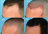 השתלת שיער בטורקיה - תהליך ההחלמה, תופעות לוואי, ואמצעי זהירות | דוקטור חן