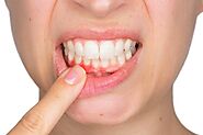 What Does Bleeding Around Your Dental Implant Mean? | PCE