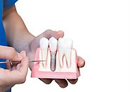 The 3 Parts Of A Dental Implant