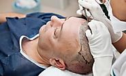The new growth in hair loss research | Life and style | The Guardian
