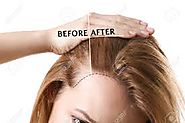 119 Best Hair Loss remedies images | Hair loss remedies, Hair loss, Hair