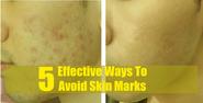 5 Effective Ways To Avoid Skin Marks