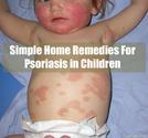 Simple Home Remedies For Psoriasis in Children